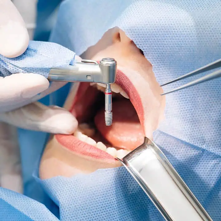 A close-up of a dental implant procedure. A persons mouth is open, surrounded by blue surgical drapes, while a dentist uses tools to insert a dental implant into the upper gum.