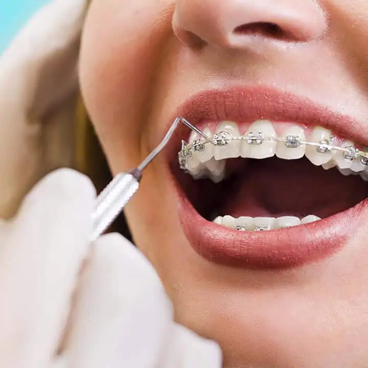 A close-up of a person’s mouth with braces, as a gloved hand uses a dental tool to examine their teeth.